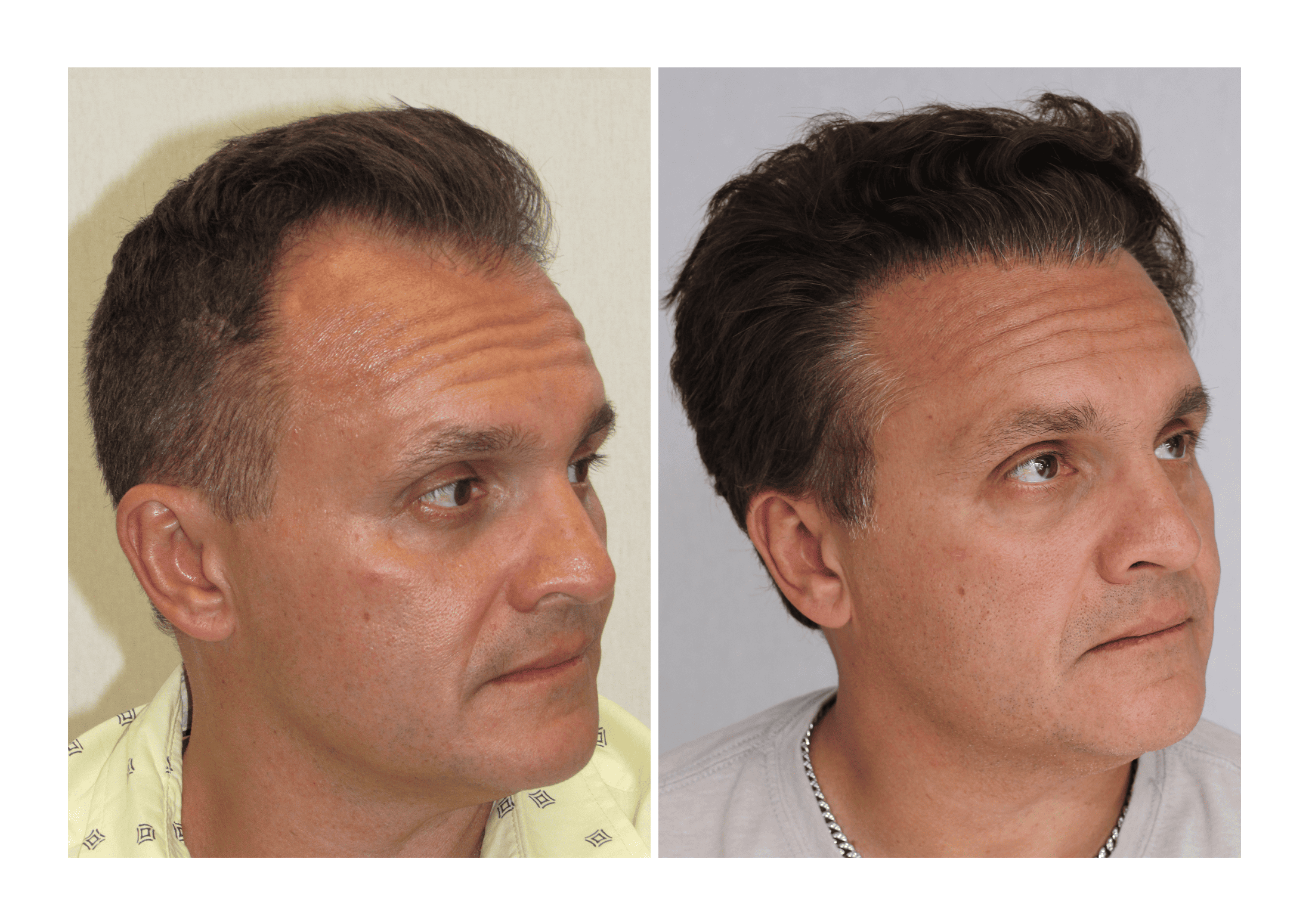 Bosley patient Dennis Gross - Before and after pictures