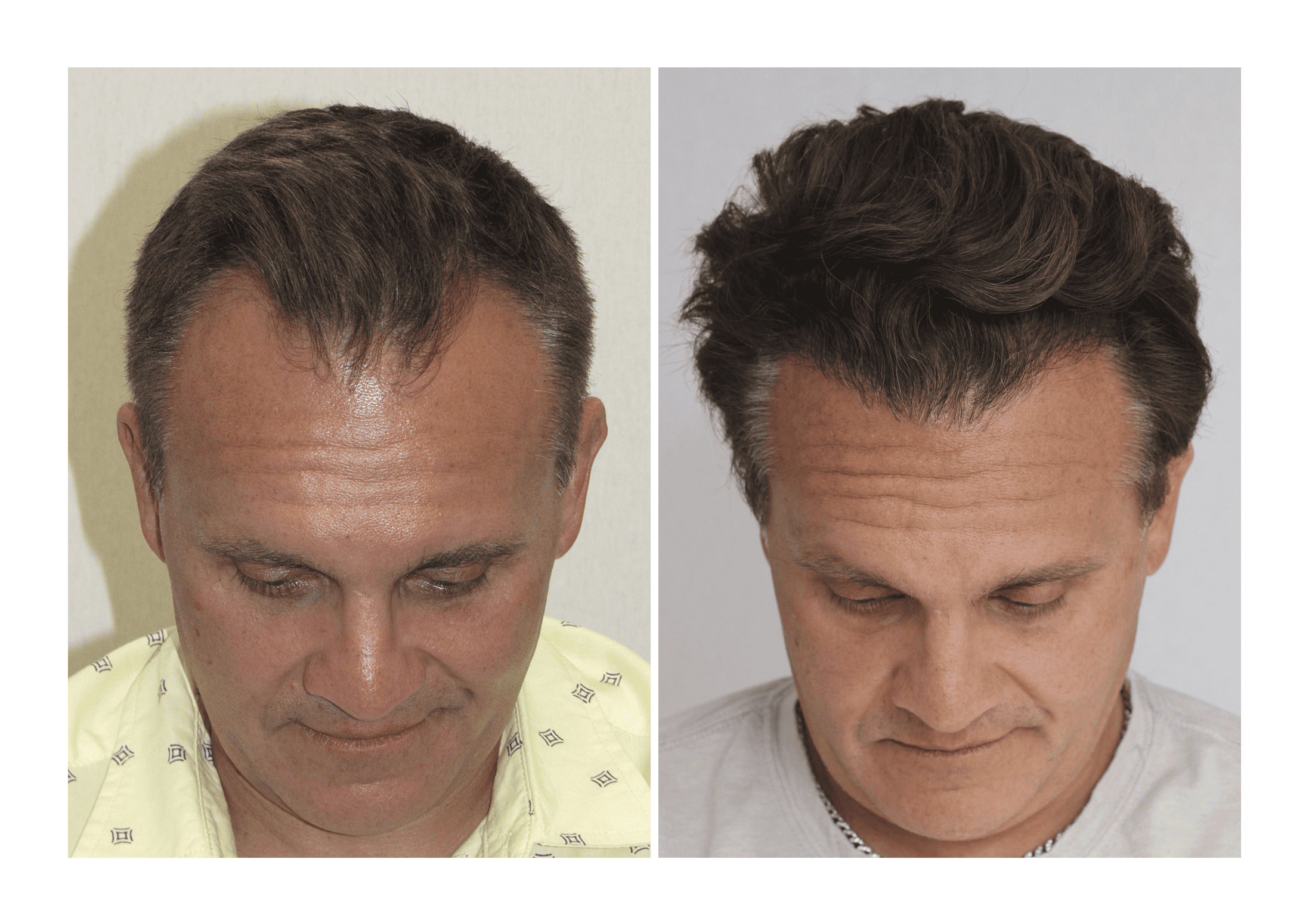 Bosley patient Dennis Gross - Before and after pictures