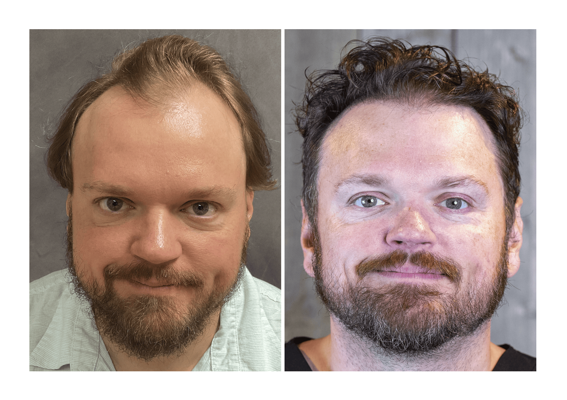 Bosley patient Josh Adams - Before and after pictures