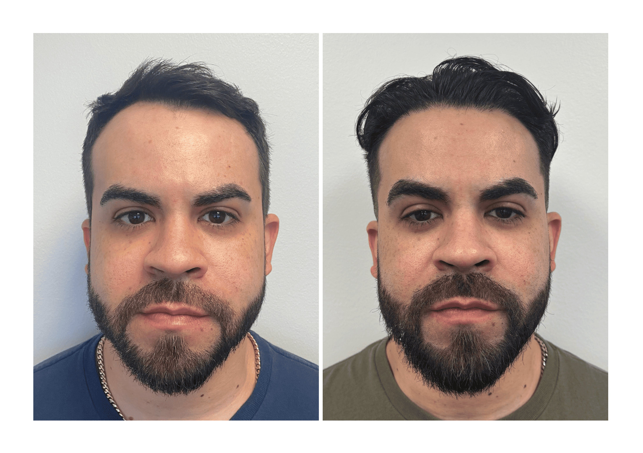 Bosley patient Edgar Bravo - Before and after pictures