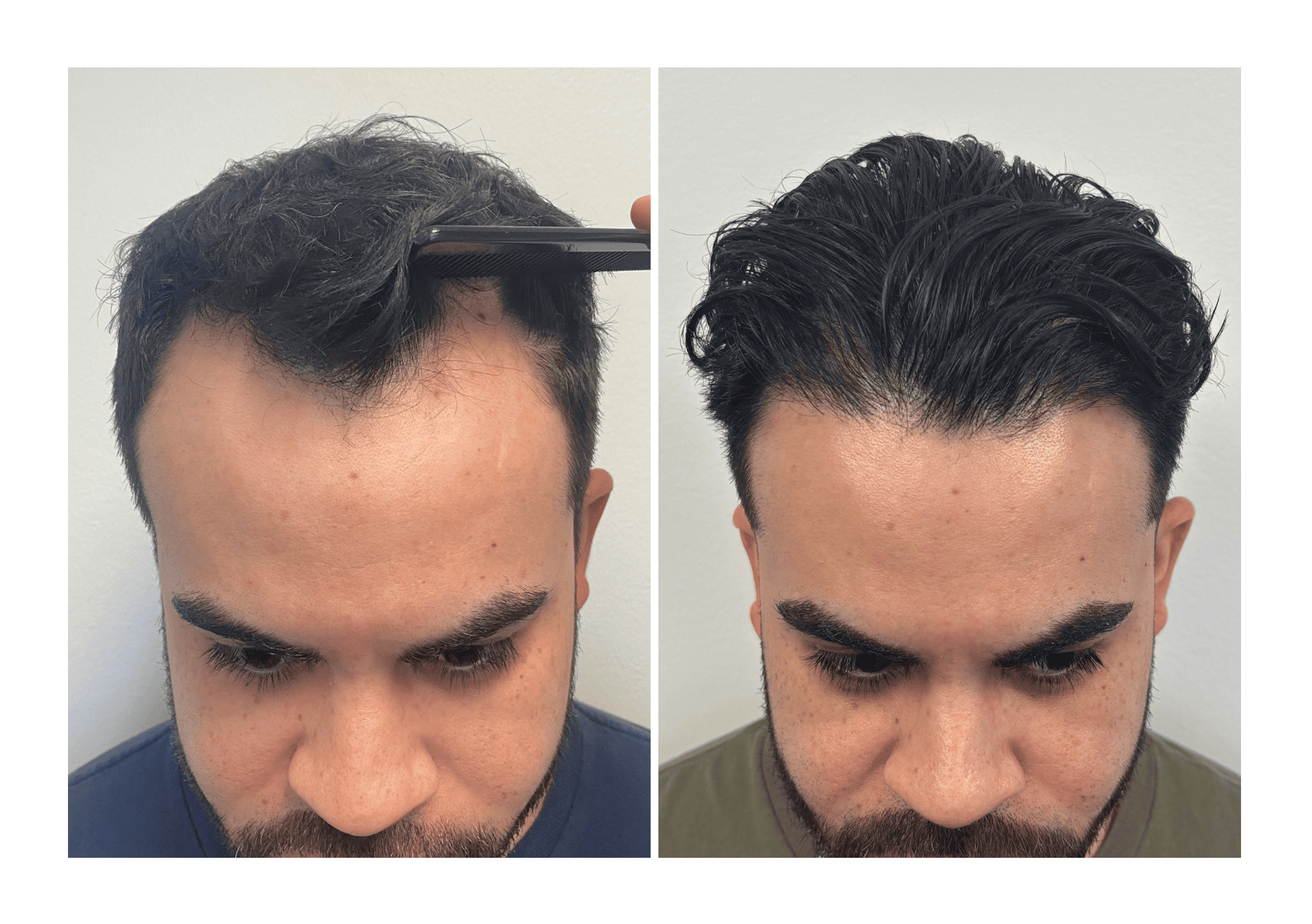 Bosley patient Edgar Bravo - Before and after pictures