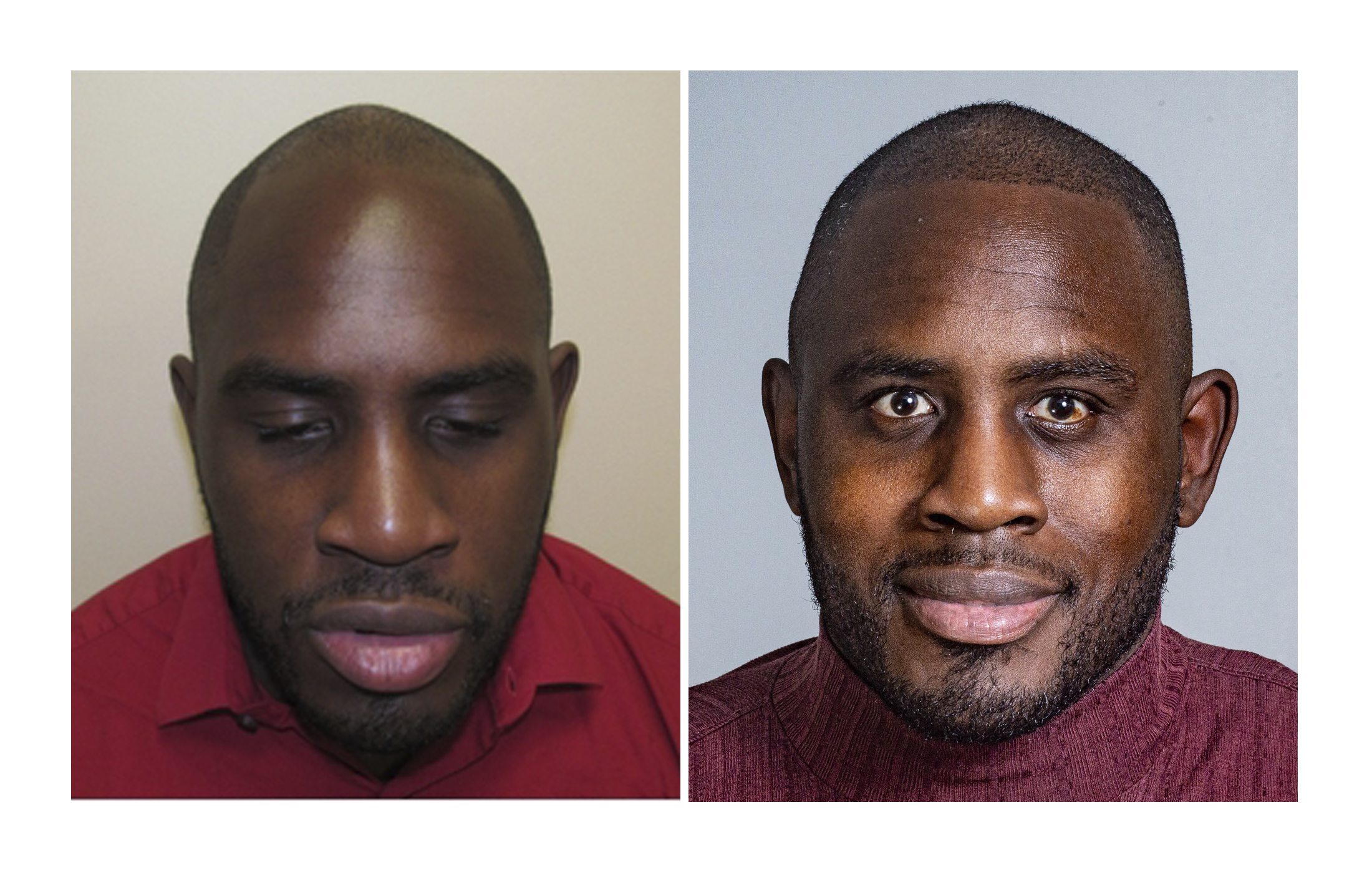 Bosley patient Edward Latimore - Before and after pictures