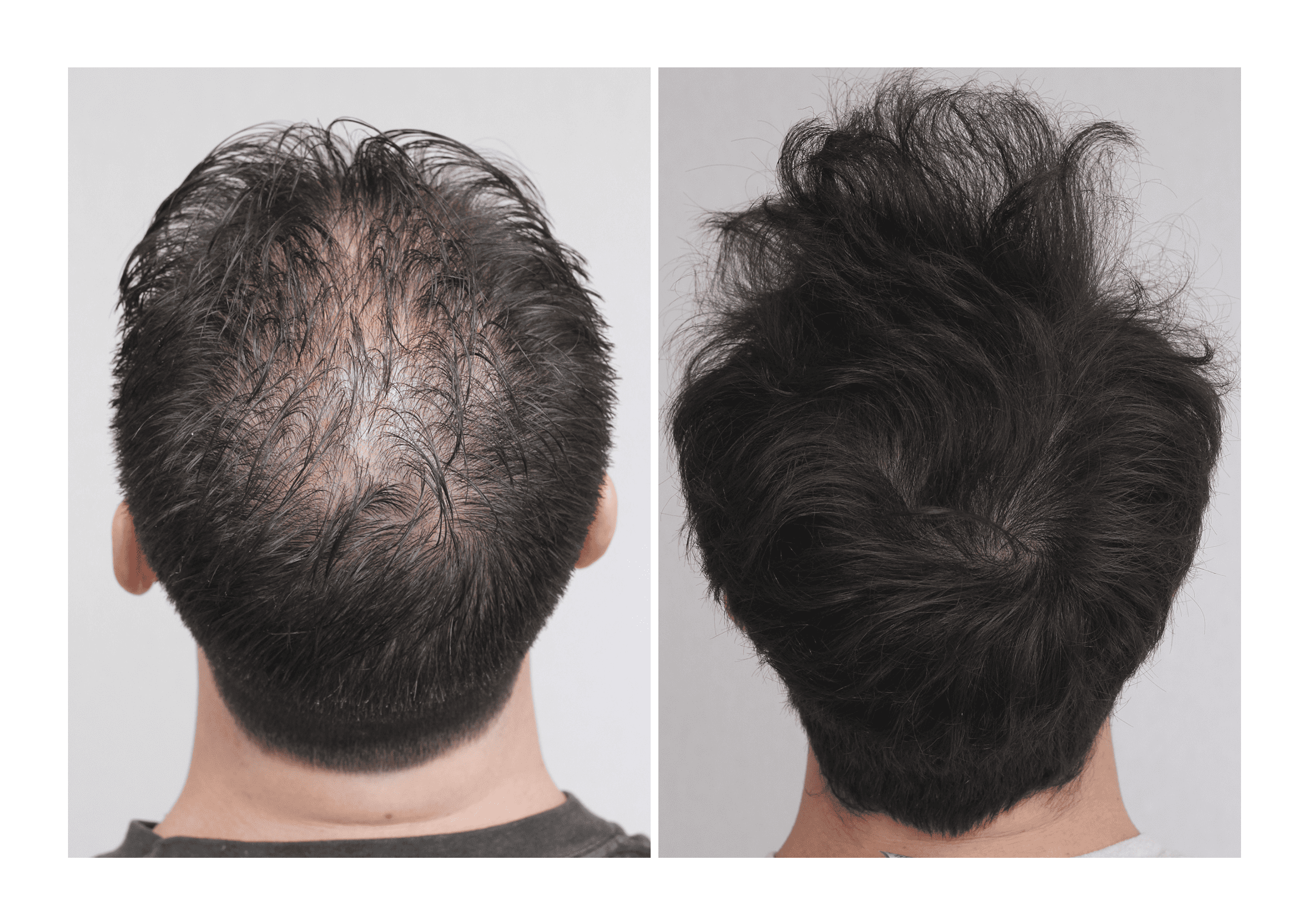Bosley patient Ethan Comer - Before and after pictures