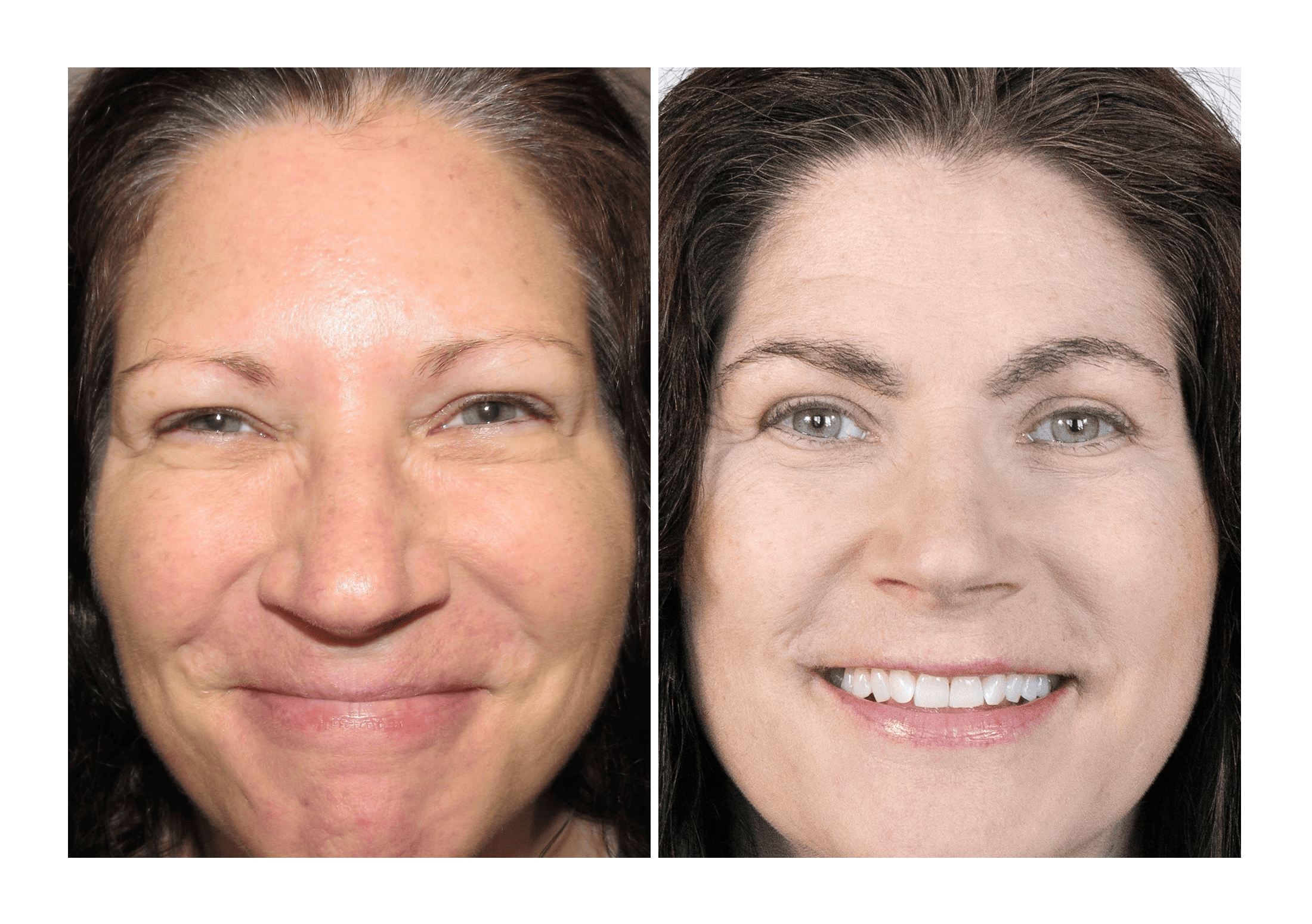 Bosley patient Dr. Heather Cook before and after pictures