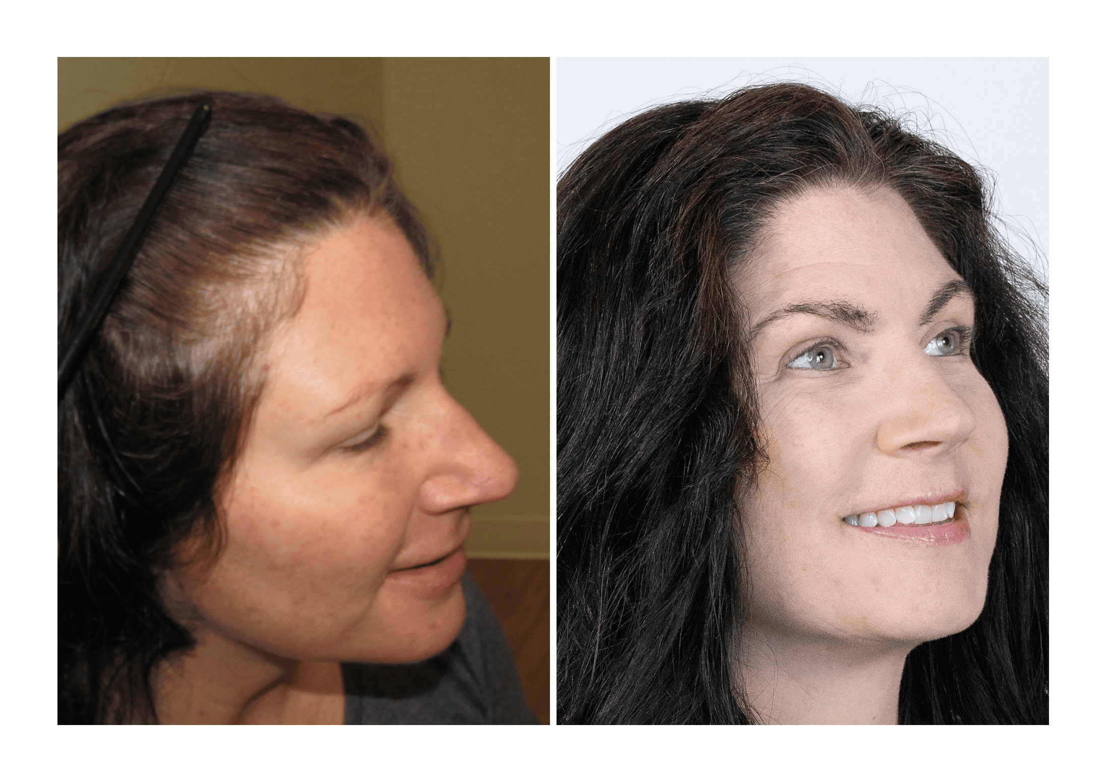 Bosley patient Dr. Heather Cook before and after pictures - Right