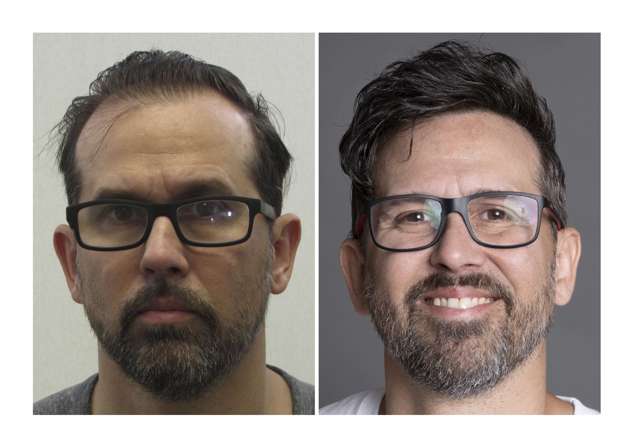 Bosley patient Jason Lewis - Before and after pictures