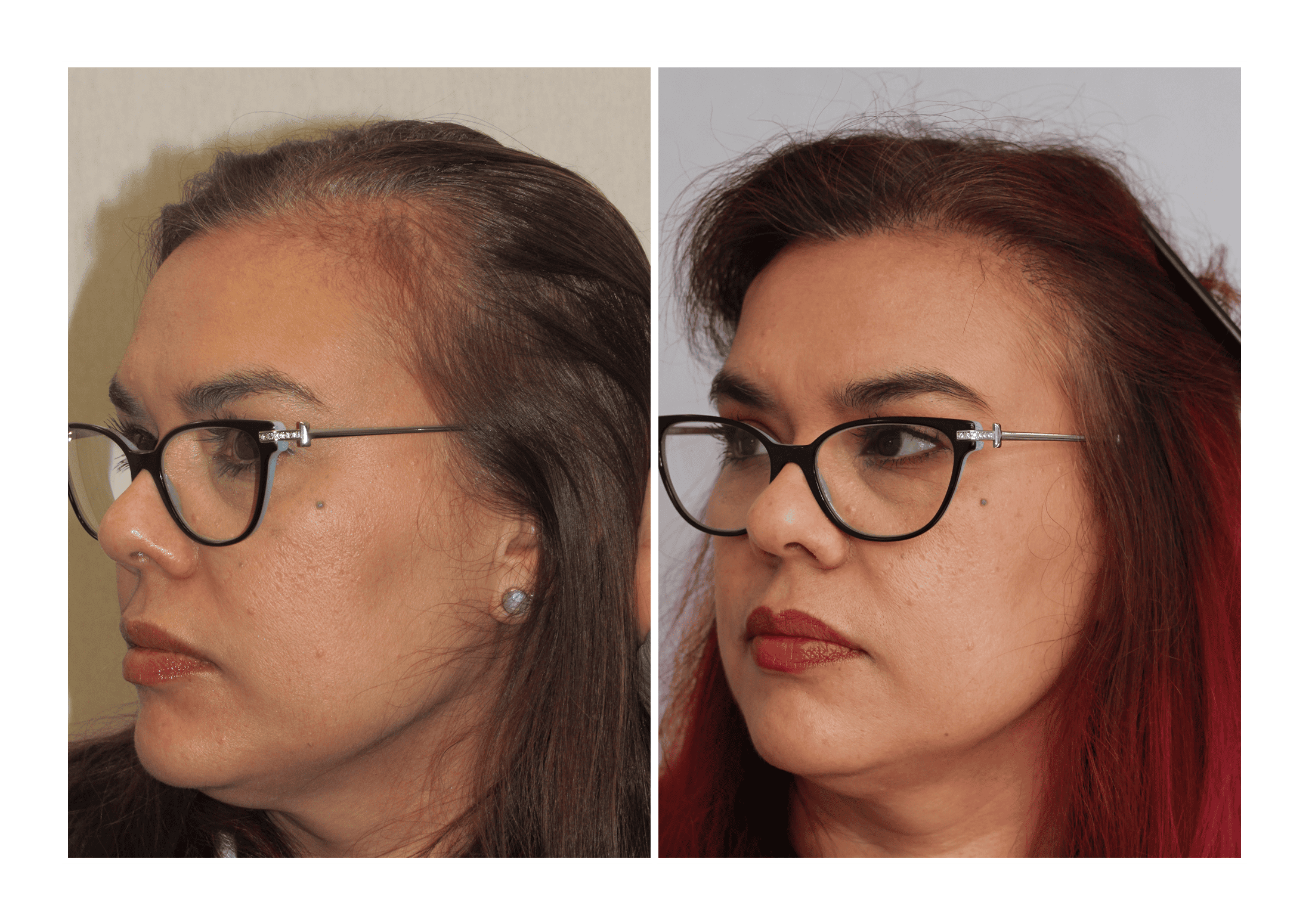Bosley patient Martha Ferro before and after pictures - left