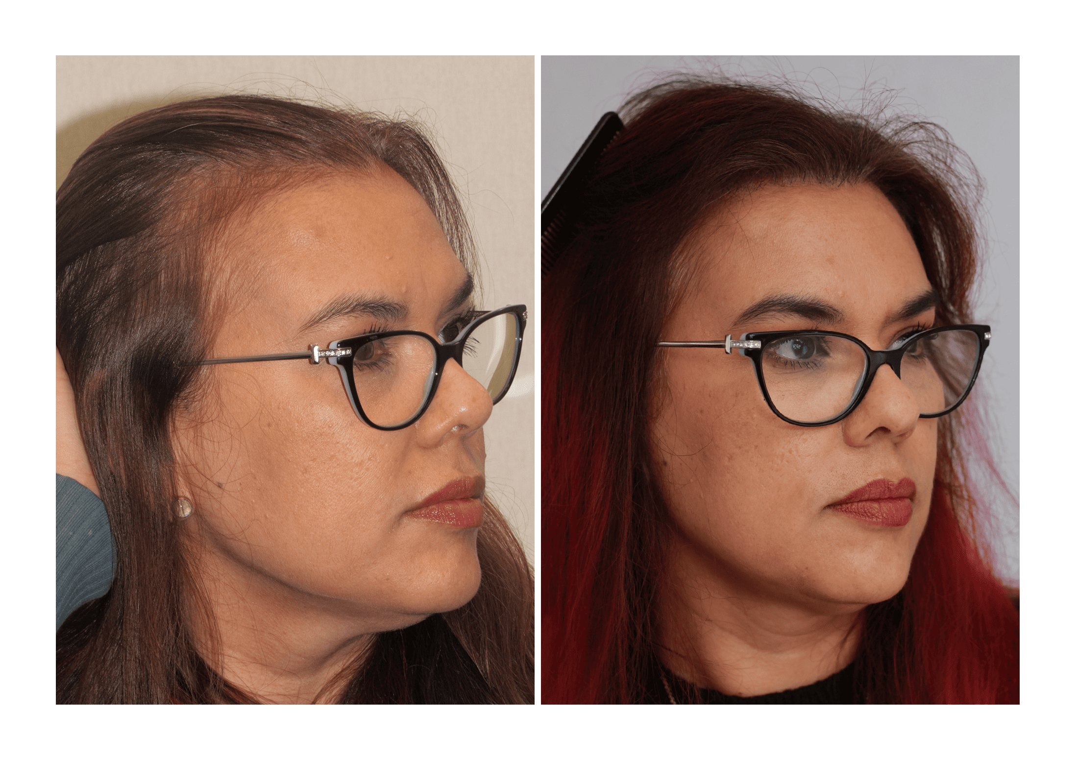 Bosley patient Martha Ferro before and after pictures