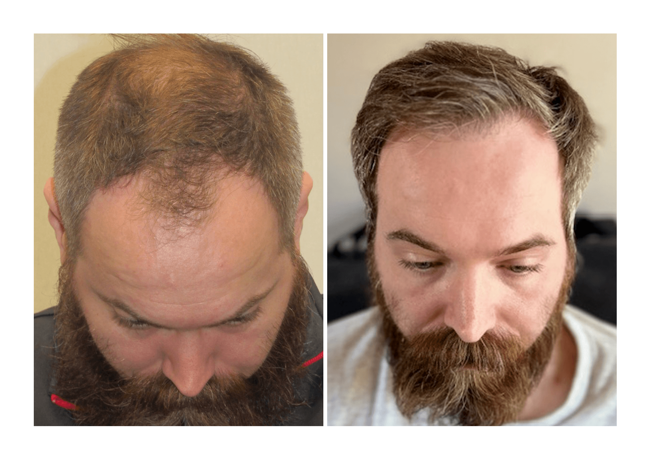 Bosley patient Matt Springhorn - Before and after pictures