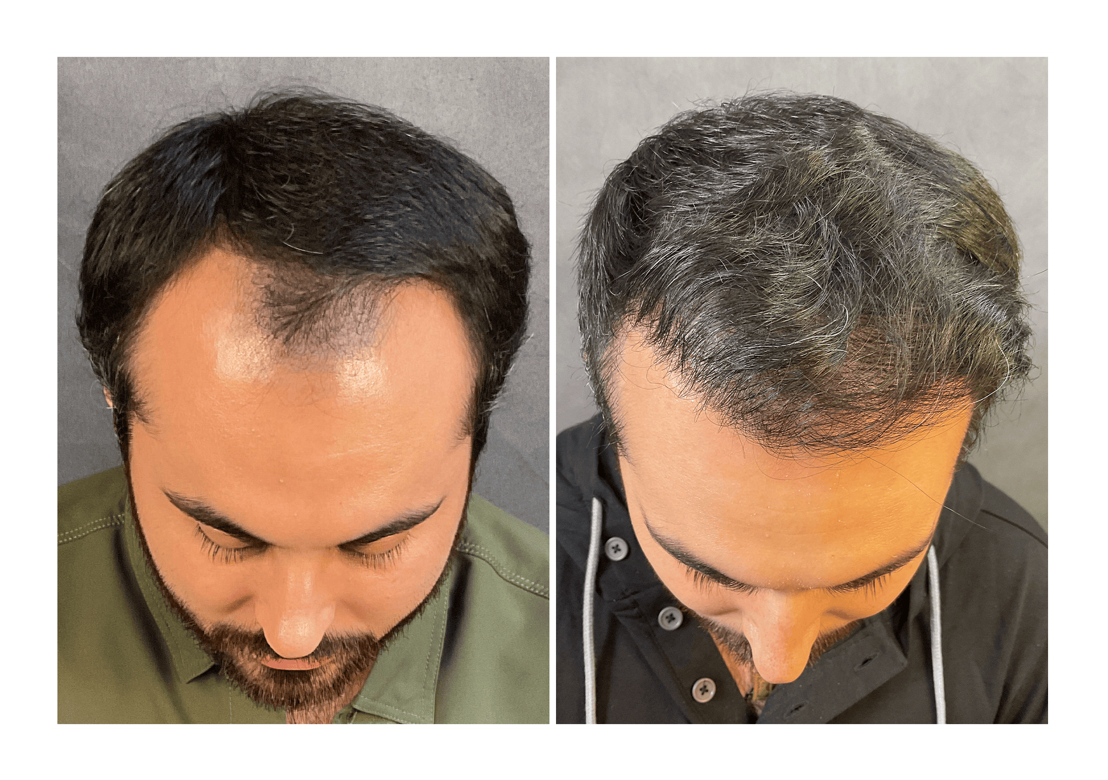 Bosley patient Matthew Hawkins - Before and after pictures