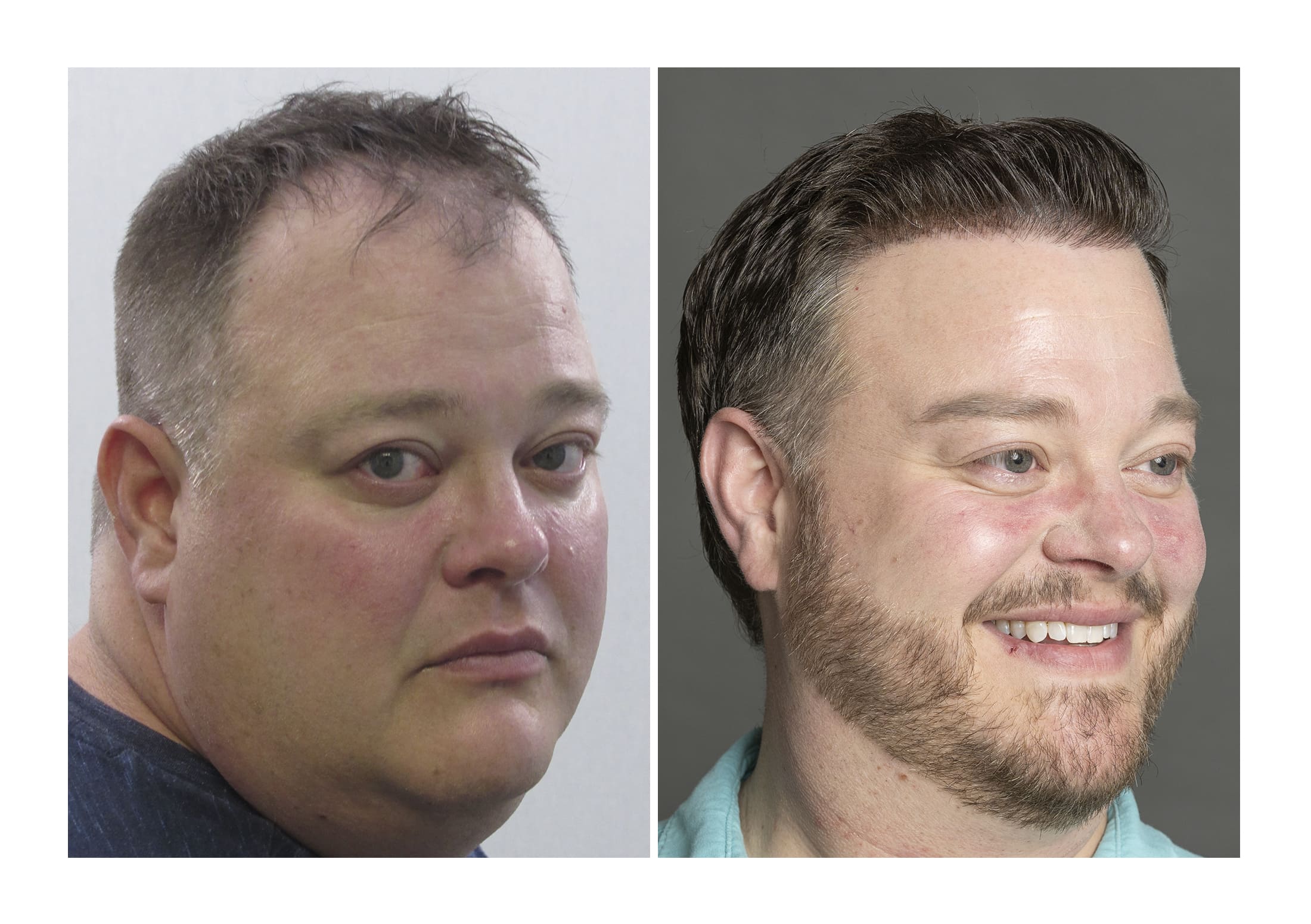 Bosley patient Matthew Zipko - Before and after pictures