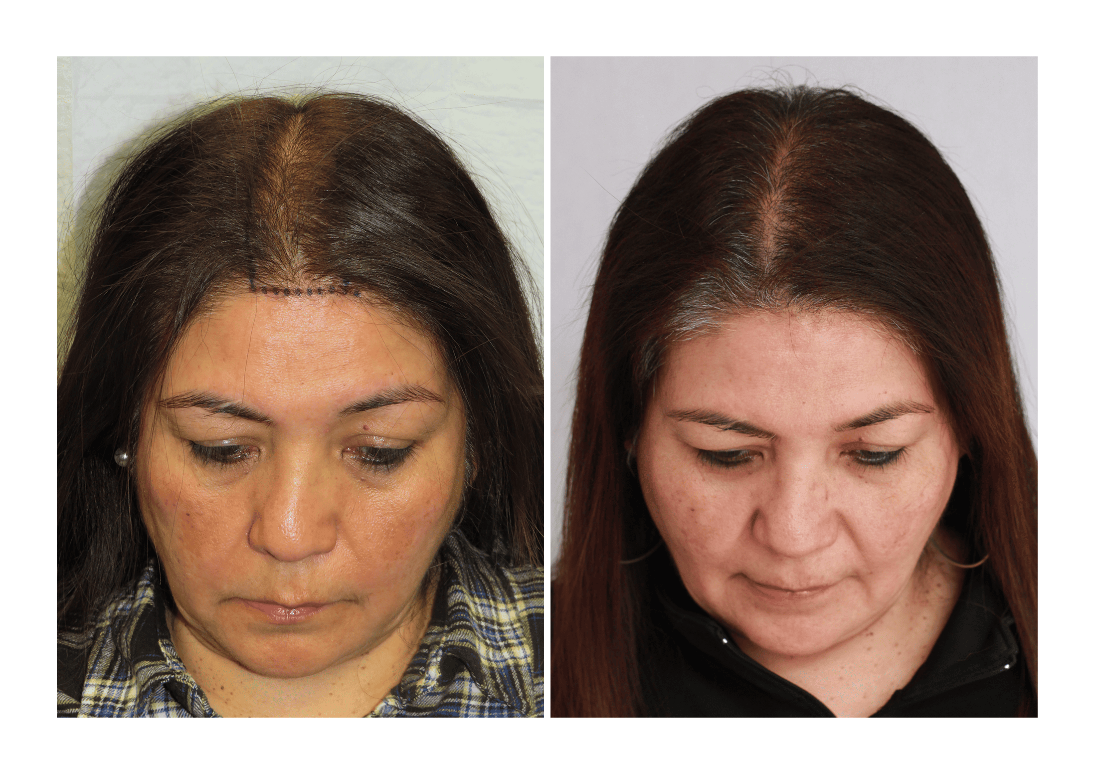 Bosley patient Mercedes Michel before and after pictures