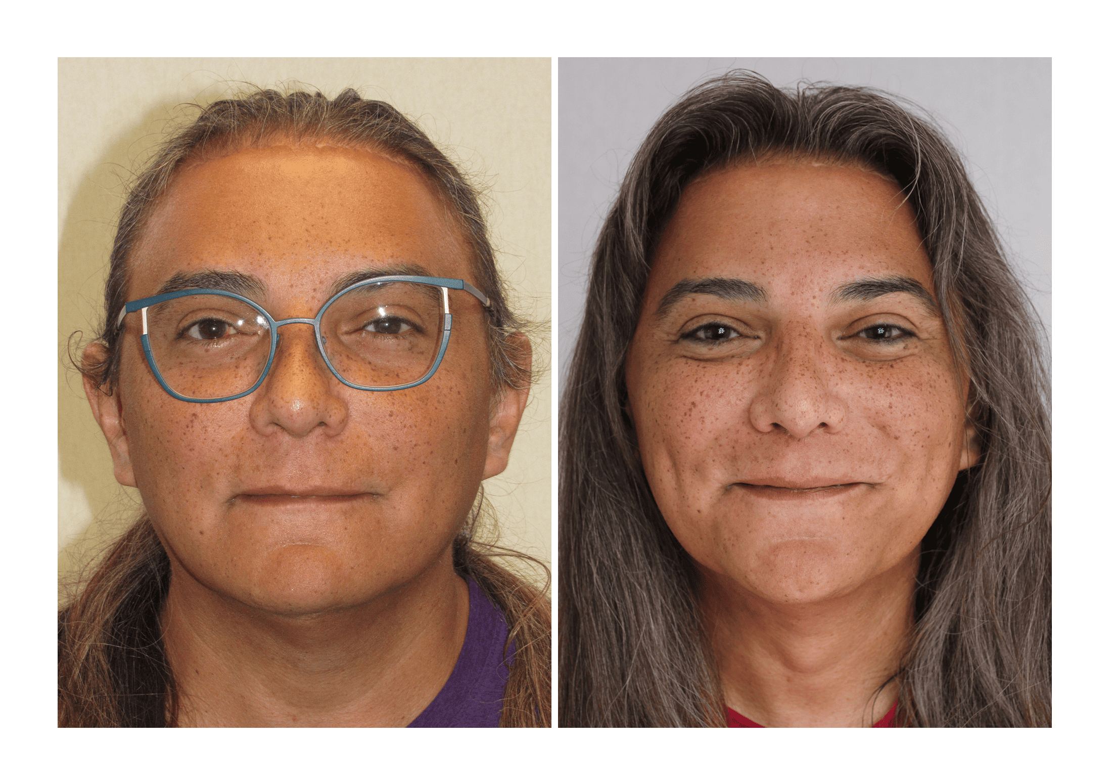 Bosley patient Nicole Sierra before and after pictures