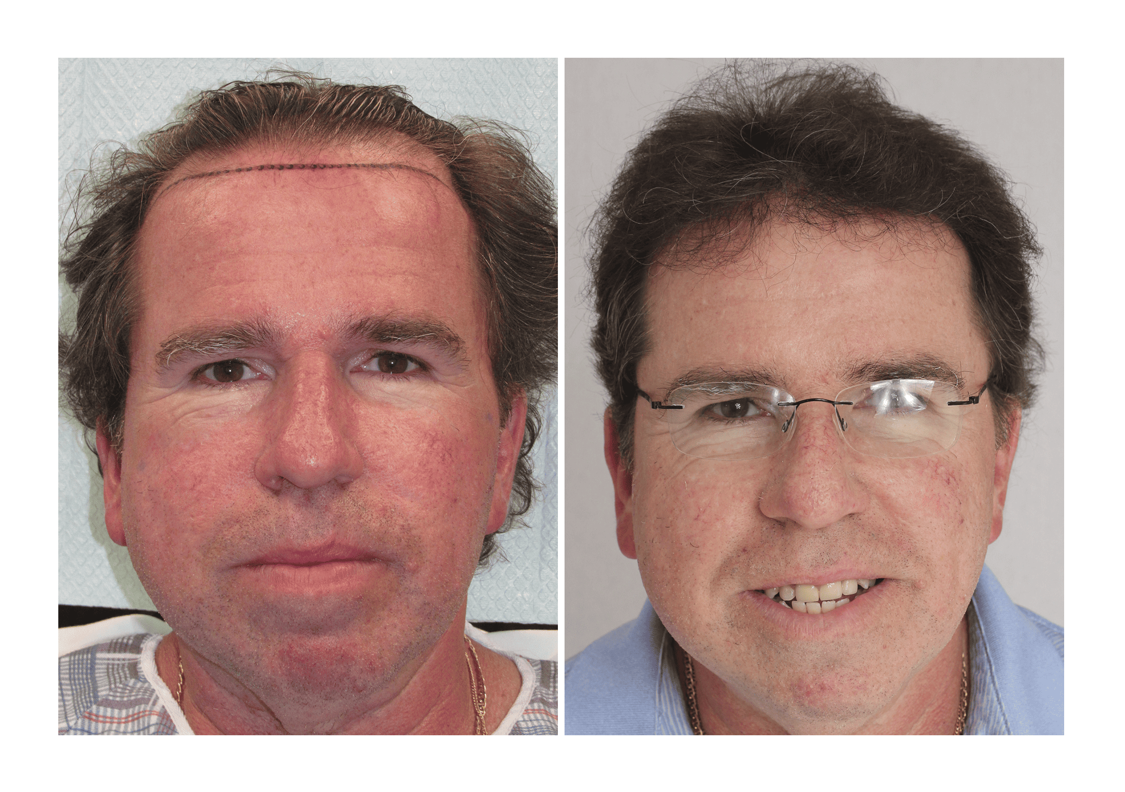Bosley patient Paul Simmons - Before and after pictures