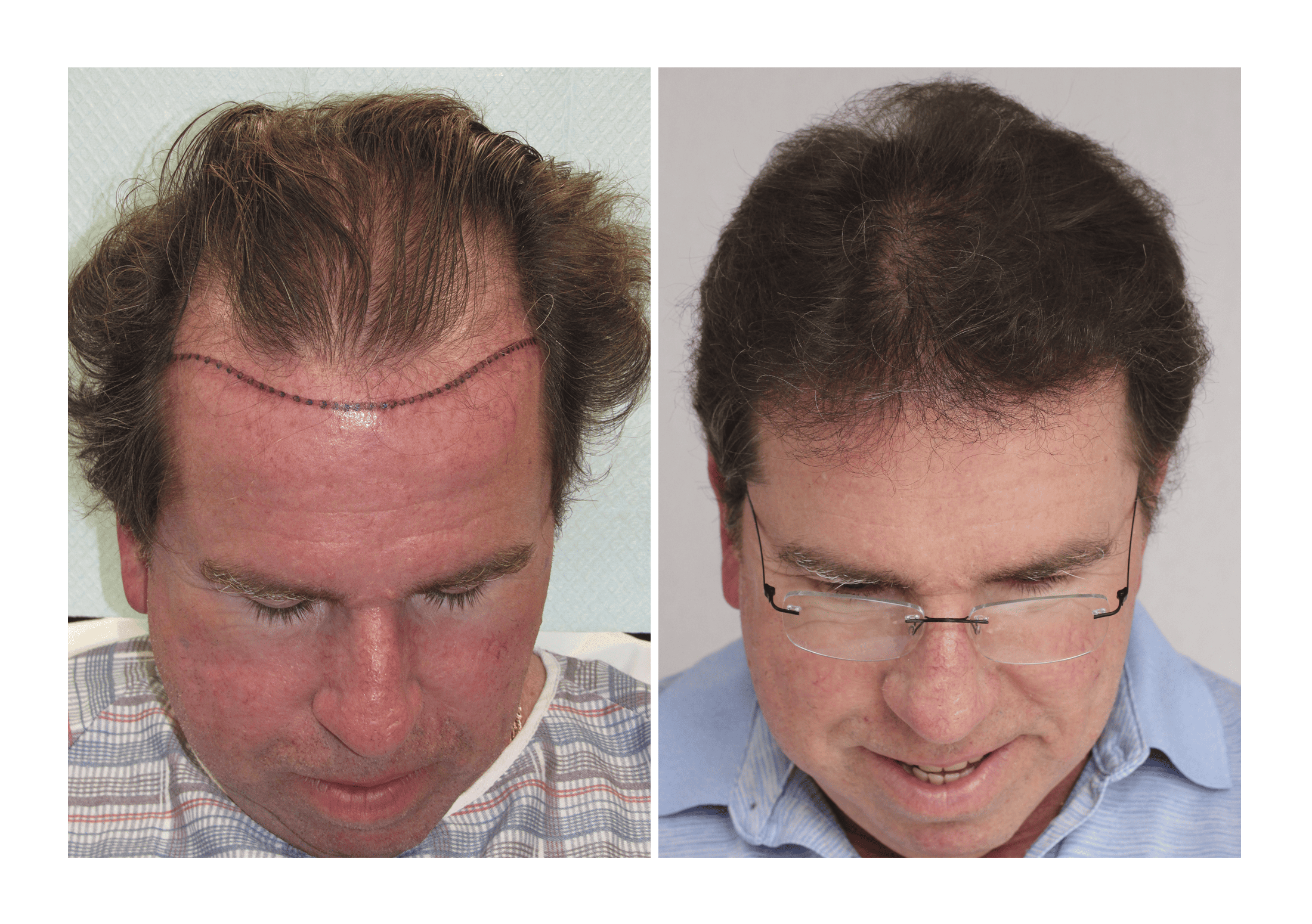Bosley patient Paul Simmons - Before and after pictures