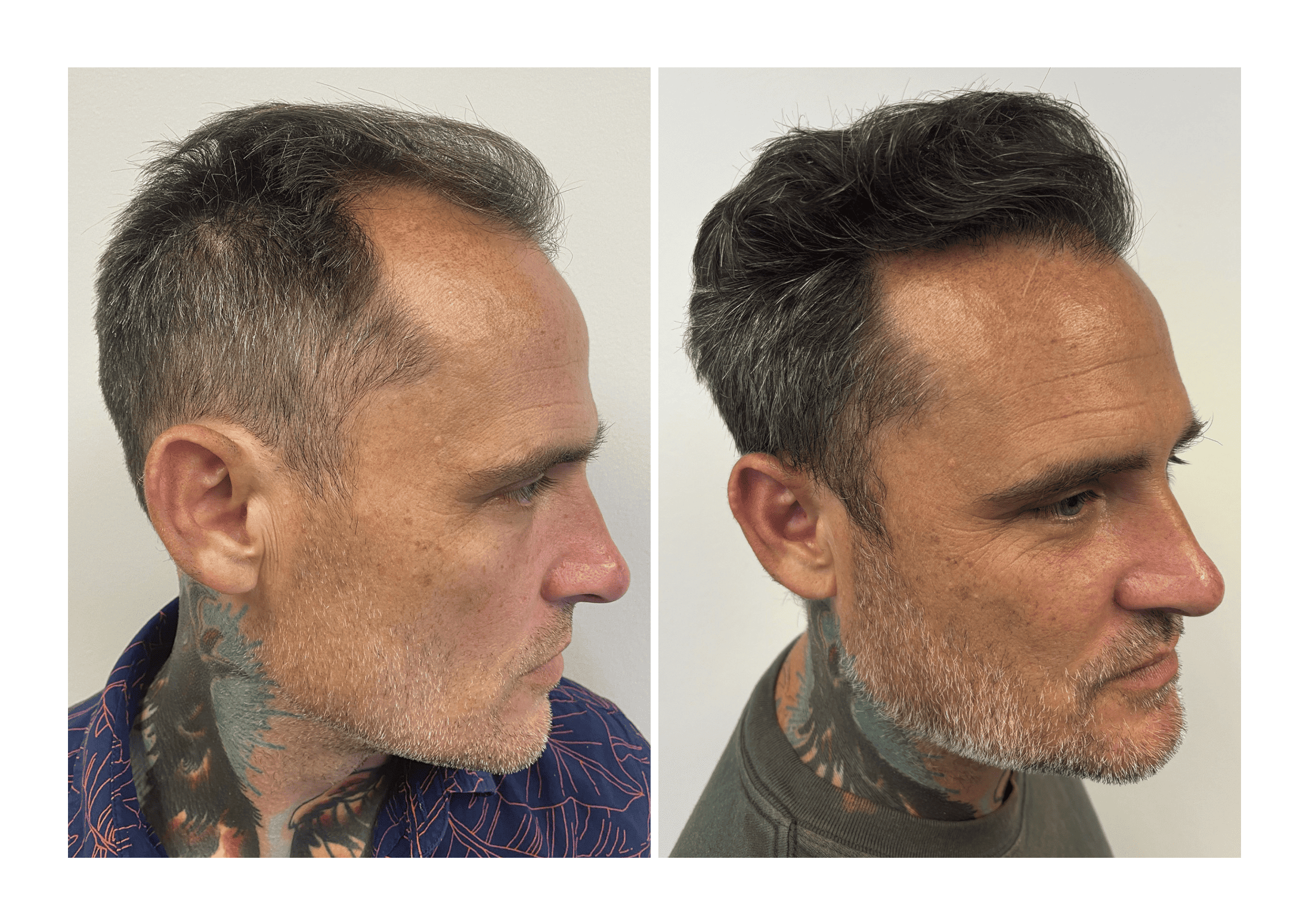 Bosley patient Philip Phillips - Before and after pictures