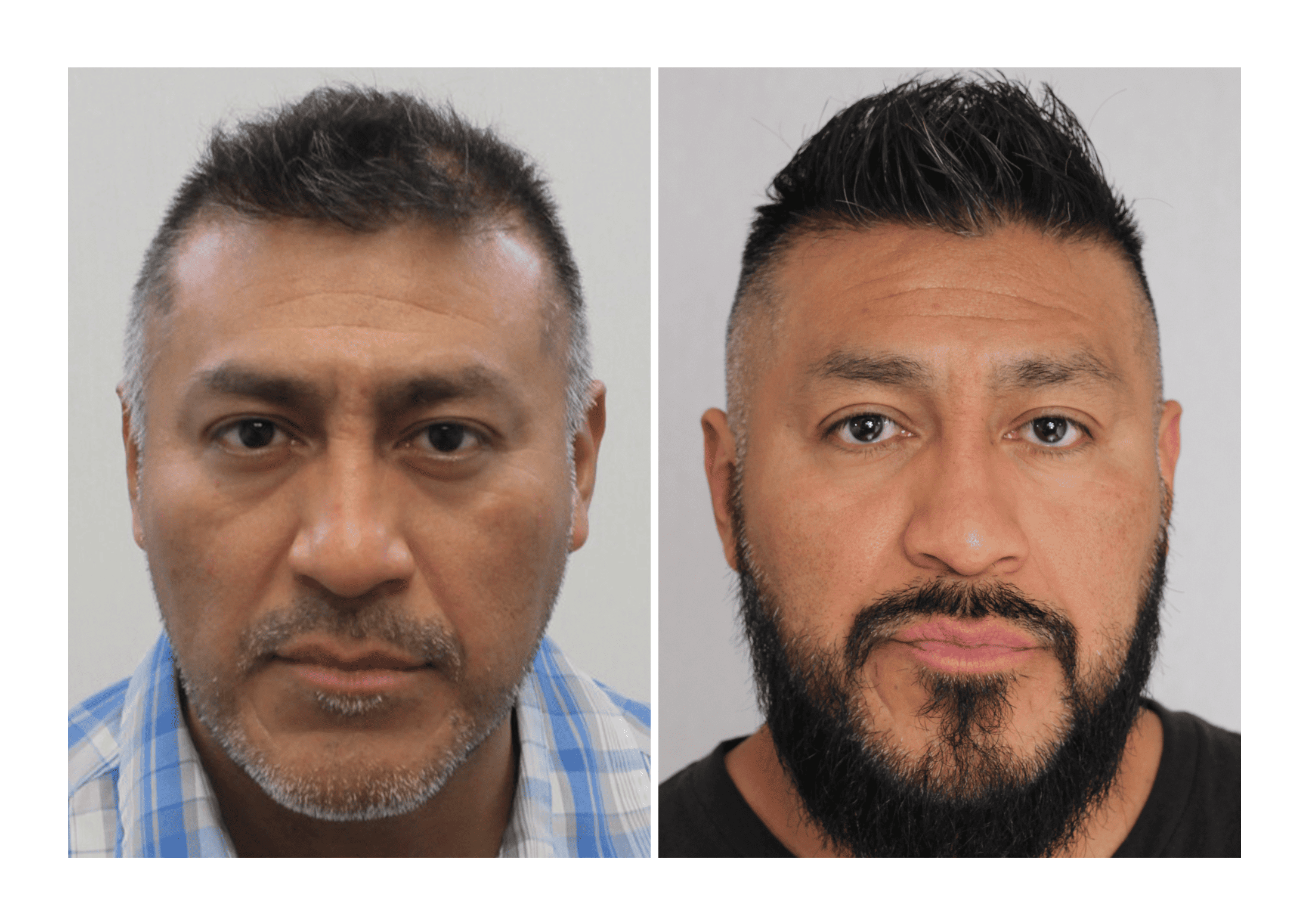 Bosley patient Rene Rojas - Before and after pictures