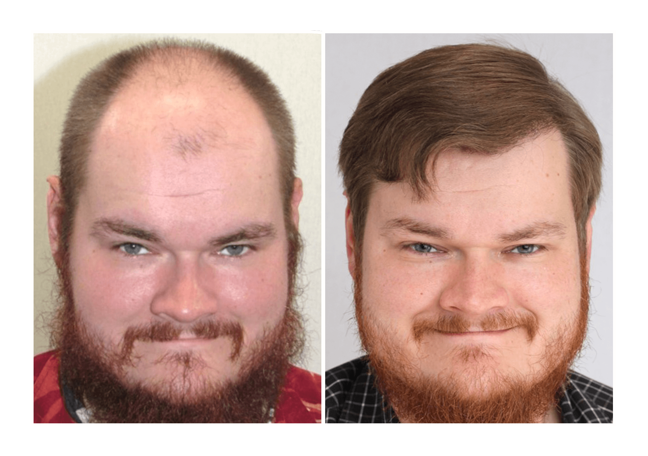 Bosley patient Tim Halvorson - Before and after pictures