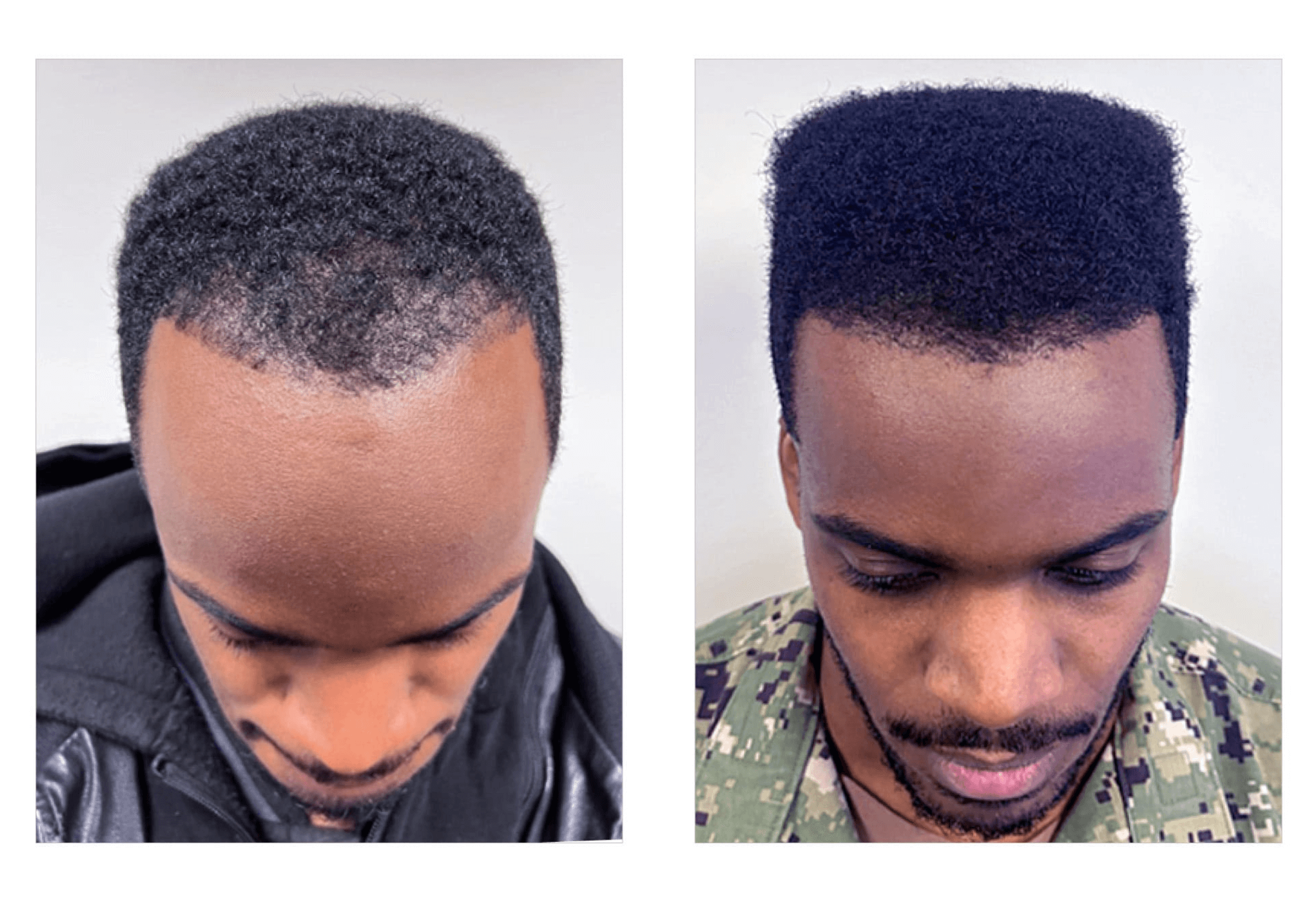 Bosley patient Drequan Rickard - Before and after pictures
