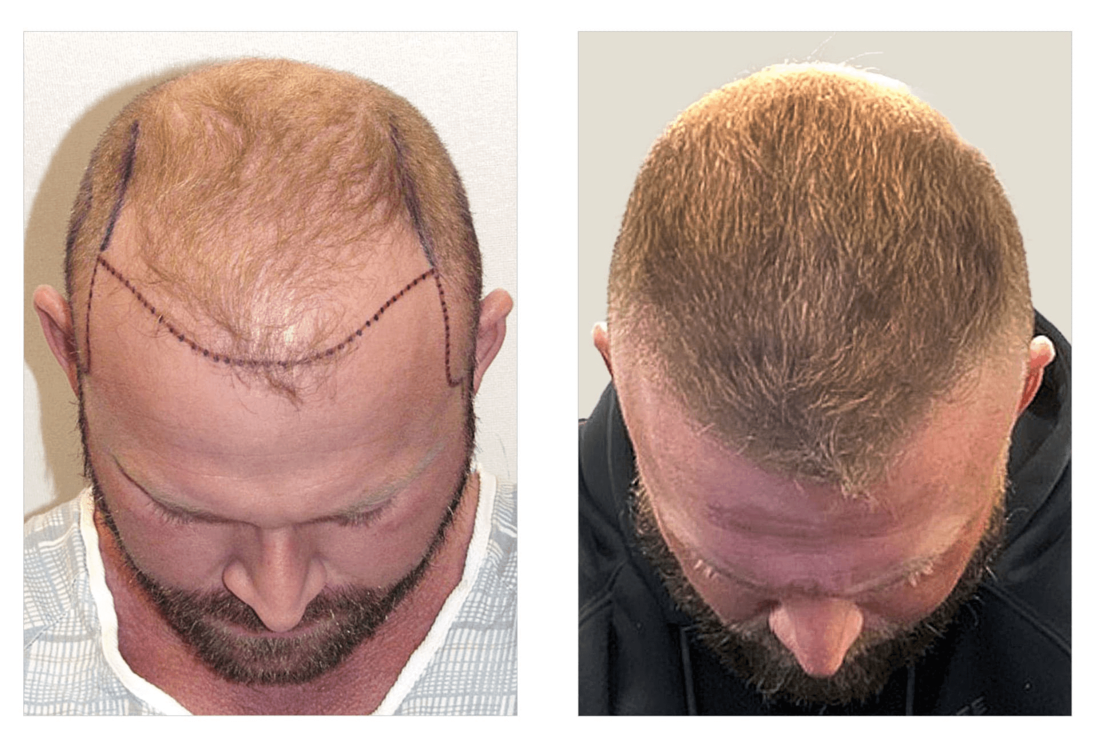 Bosley patient Jeremy Gourley - Before and after pictures