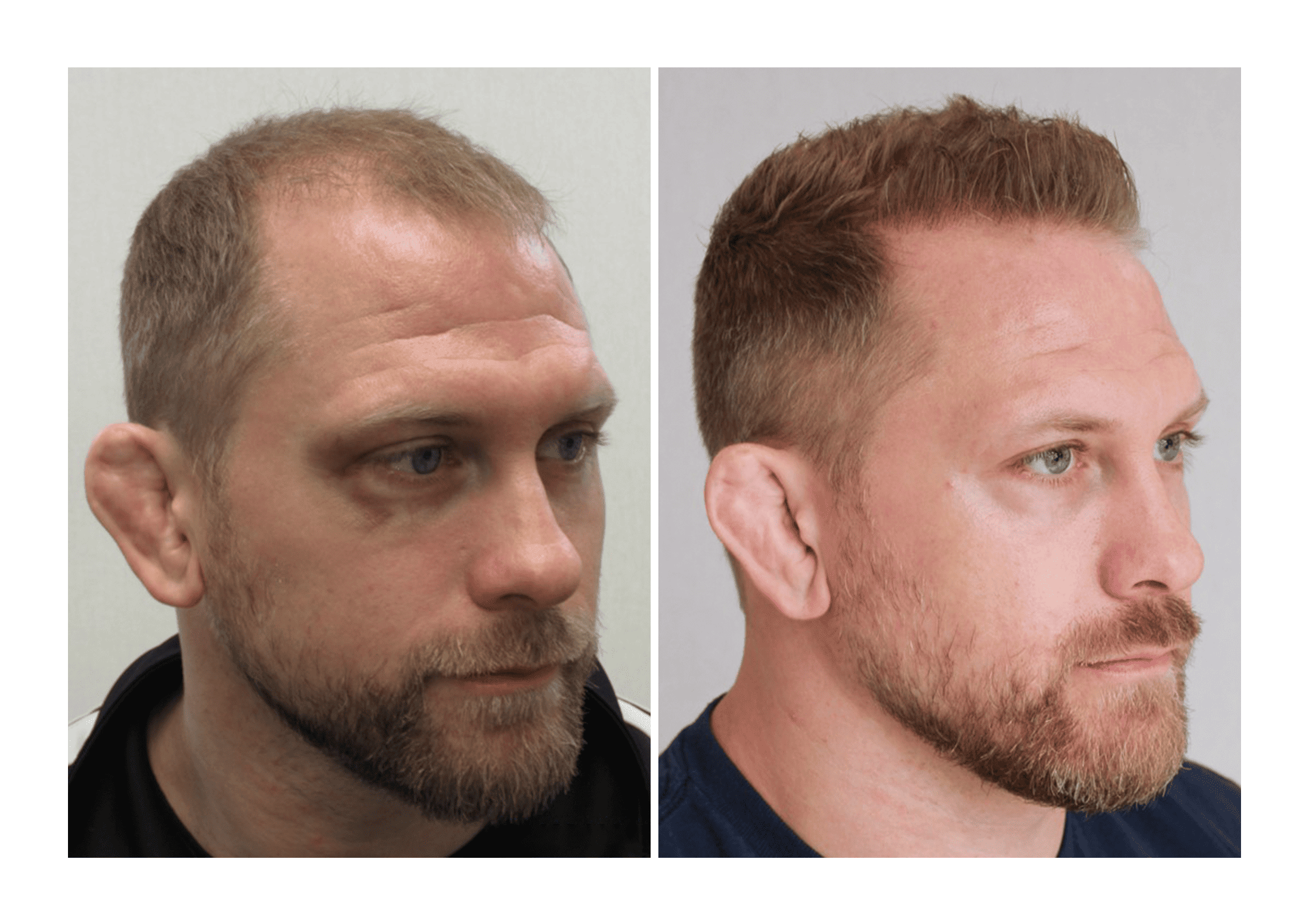Bosley patient Zach Ottow - Before and after pictures