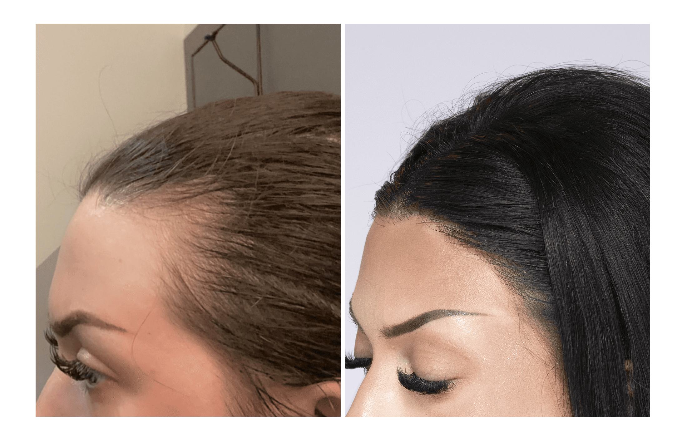 Bosley patient Britany Geidl before and after pictures - left