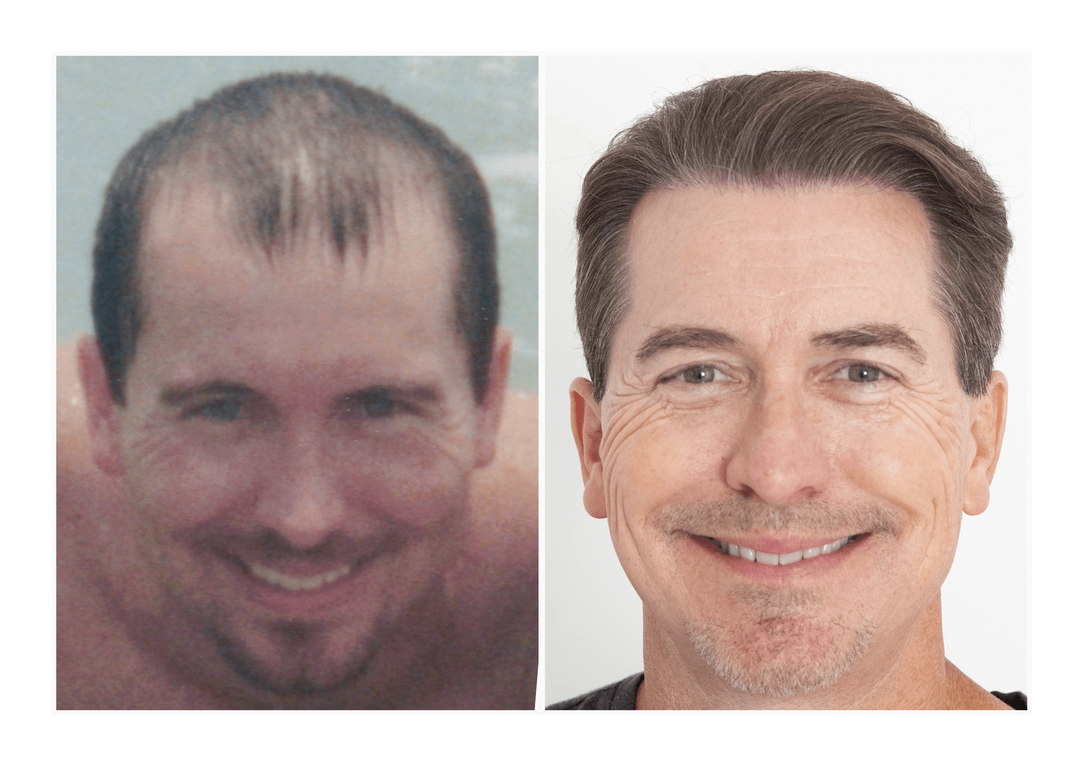 Is Bosley Hair Restoration Worth It Hair Transplant Before/After Results for Men - Bosley Hair Transplant