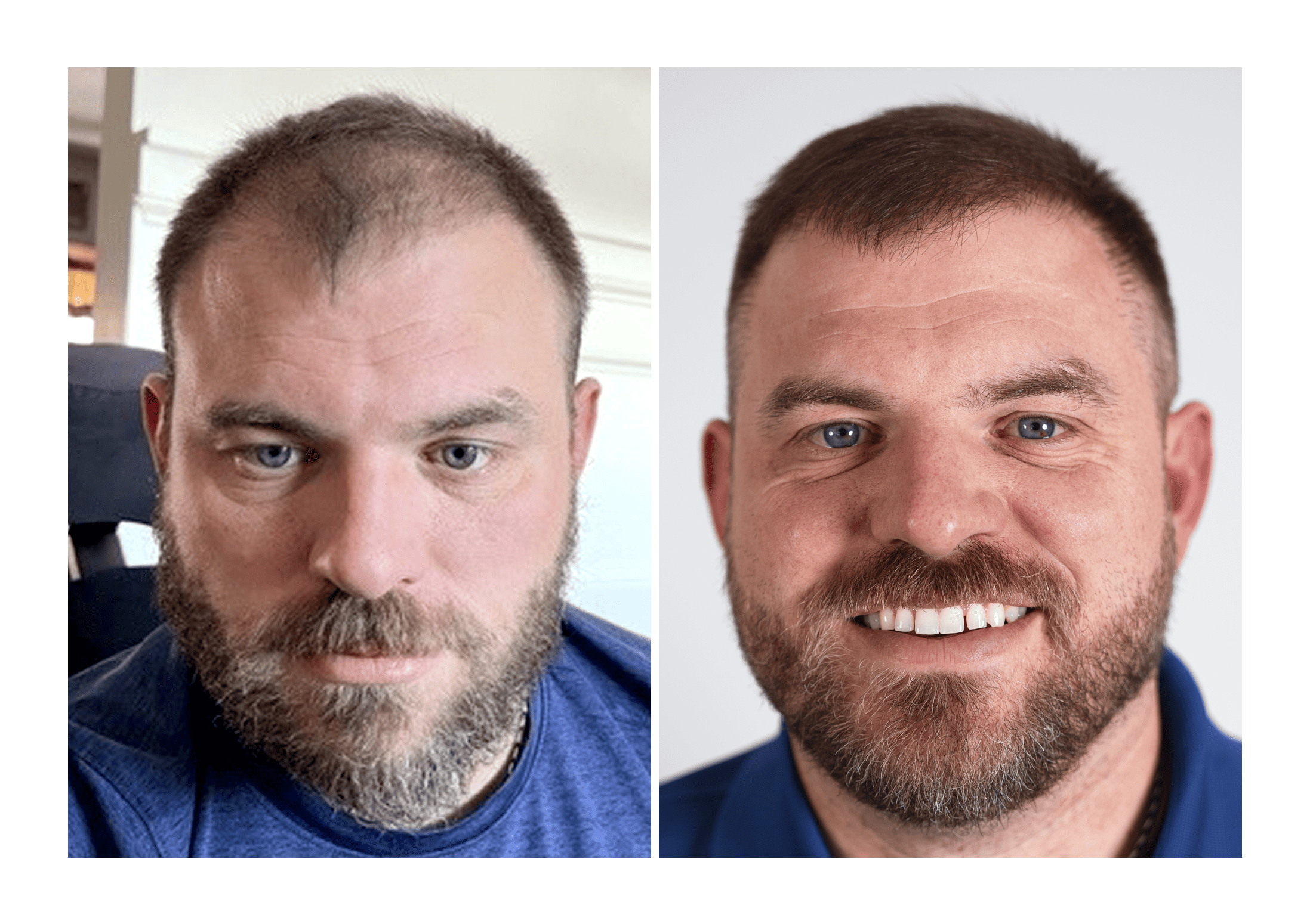 Is Bosley Hair Restoration Worth It Hair Transplant Before/After Results for Men - Bosley Hair Transplant
