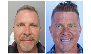 Bosley Patient Mark L Before and After Images