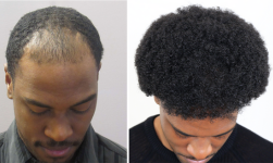 Bosley patient Johnathin Richarson before and after - Tilt Down photos