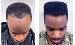 Bosley patient Drequan R. before and after