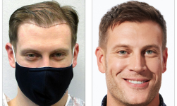 Bosley patient Erick S. Before and after