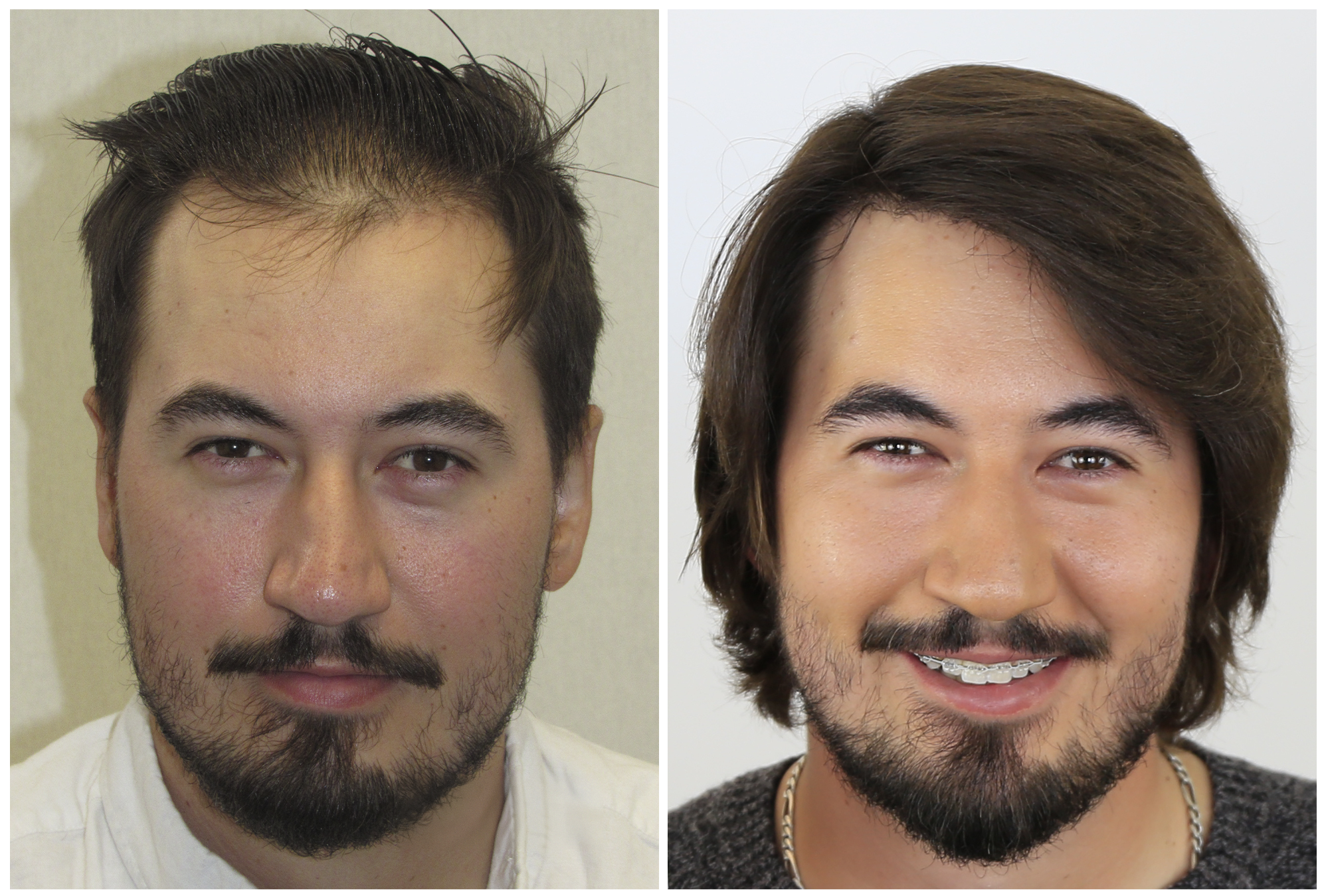 Bosley patient Devin H, Before and After