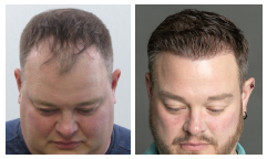 Bosley patient Matthew Z. before and after