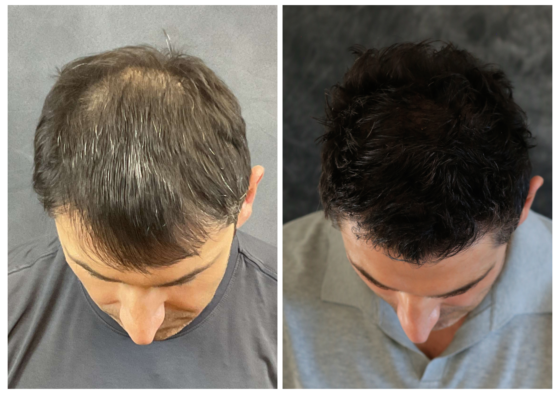 Stuart O. before and after