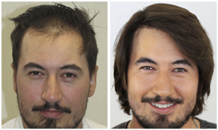 devin-before-after-308x183-v1