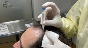 BHI (Bosley Hair Implanter)