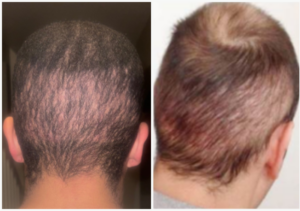 Overharvested donor area.