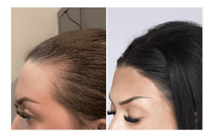 Facial Framing Hair Transplants: Before and After Photos