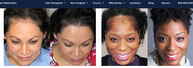 Facial Framing Hair Transplants: Before and After Photos